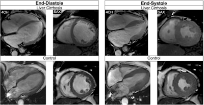 Balanced steady-state free precession cine-images at end-diastole and end-systole (4-chamber (4CH) and midventricular short axis (SAX) views) of a 51-year-old male patient with liver cirrhosis due to primary sclerosing cholangitis (MELD score: 16 points, Child-Pugh class B) and of a 53-year-old male control. The patient showed a higher LVEDVi (108.3 versus 71.8 mL/m2)/RVEDVi (112.1 versus 67.5 mL/m2), a higher LVEF (73.0 versus 64.0%)/RVEF (60.5 versus 57.0%), and increased biventricular strain (LVGLS: −26.0%, LVGRS: 39.9%, LVGCS: −20.4%, RVGLS: −22.9%, RVGRS: 12.3%, RVGCS: −8.0%) than the age-matched control (LVGLS: −14.0%, LVGRS: 19.0%, LVGCS: −17.0%, RVGLS: −22.8%, RVGRS: 13.3%, RVGCS; −7.3%). Furthermore, the patient showed an elevated ECV (32.0%) compared to the control (22.4%).