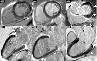 Phase-sensitive inversion recovery (PSIR) images of the left ventricle (LV) in short-axis (SAX) views and the corresponding 2-chamber (2CH) or 3-chamber (3CH) views, showing the distribution of non-ischemic late gadolinium enhancement (LGE) in three exemplary study patients. Left: Punctiform subepicardial LGE of the midventricular inferior LV in a 63-year-old male patient with cirrhosis due to primary sclerosing cholangitis (MELD score: 18 points, Child-Pugh class B). Middle: Linear mid-myocardial LGE of the inferior LV in a 54-year-old male liver cirrhosis patient with chronic Hepatitis C virus infection (MELD score: 15 points, Child-Pugh class B). Right: Linear mid-myocardial LGE of the lateral basal LV in a 57-year-old male liver cirrhosis patient with chronic Hepatitis C virus infection (MELD score: 6 points, Child-Pugh class B).