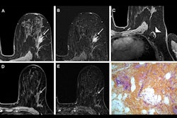 2025 07 01 Radiology Mri Breast Thumbnail