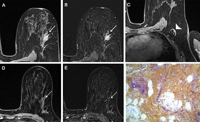 Example of a true-positive radiologic complete response at dynamic contrast-enhanced MRI in a 53-year-old woman who underwent neoadjuvant chemoimmunotherapy for triple-negative breast cancer. (A-C) Axial T1-enhanced dynamic contrast-enhanced MRI scans acquired before treatment. The cancer appeared as a spherical 20-mm mass enhancement in the left breast, indicated by arrows on (A) native and (B) subtracted images. (C) Native image shows the absence of axillary node involvement (arrowhead). (D, E) At post-treatment MRI, no residual enhancement was observed within the initial tumor bed, marked by a coil (dashed arrow), on (D) native and (E) subtraction scans. (F) Pathologic examination after chemoimmunotherapy revealed no residual invasive cancer in the breast or lymph nodes, confirming a pathologic complete response (hematoxylin-eosin stain; magnification, 200×).