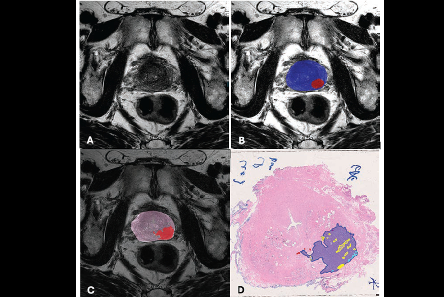2025 07 17 Ajr Evaluating Ai Prostate Biparametric Mri Thumbnail