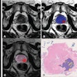 2025 07 17 Ajr Evaluating Ai Prostate Biparametric Mri Thumbnail