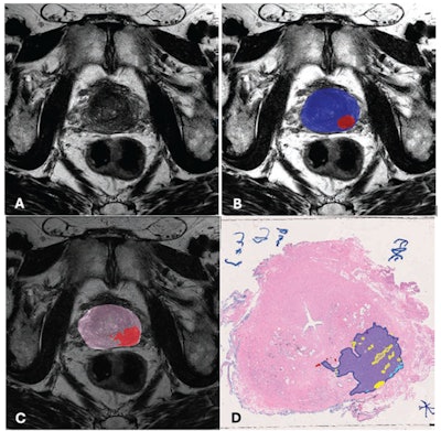 Lesion Identification by AI and Histopathologic Annotation. 77-year-old man with serum PSA of 17.8 ng/mL. A) T2-weighted (T2W) MRI shows hypo-intensity in the left posterolateral peripheral zone. B) AI segmentation map overlaid on T2W image shows predicted prostate segmentation boundary in blue and PCa-suspicious lesion prediction segmentation in red. C) Ground truth histopathology slide registered to MR image shows annotated lesion segmented in red. D) Histopathologic annotation of whole mount prostate tissue after radical prostatectomy. This patient was found to have Gleason 4+3 disease in the region marked in blue. Yellow outlines represent cribriform architecture, red represents regions of Gleason 3, and light blue represents areas of lymphovascular invasion. Images and caption courtesy of the AJR.