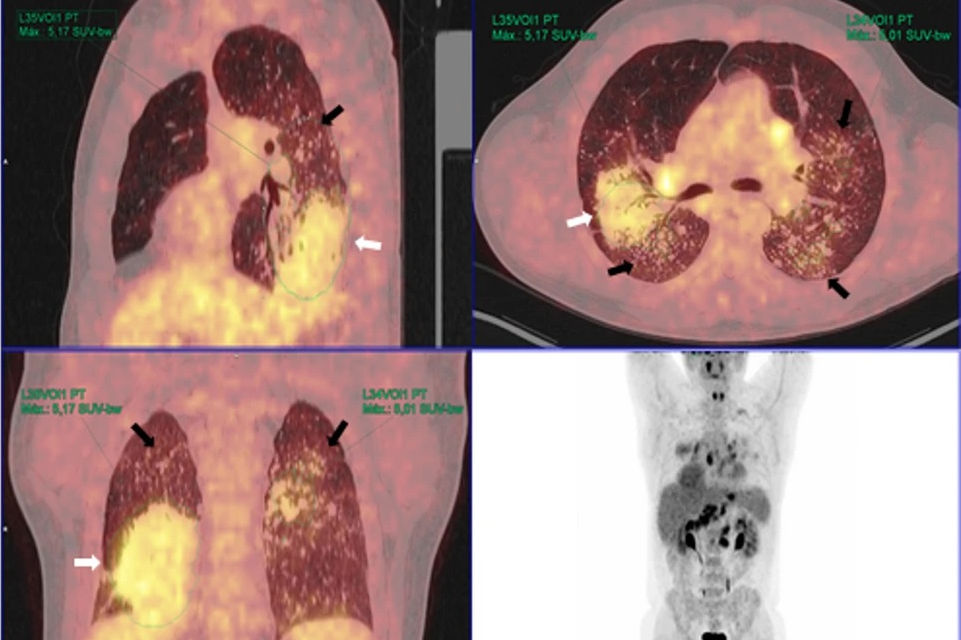 2025 07 18 Silicosis Thumbnail