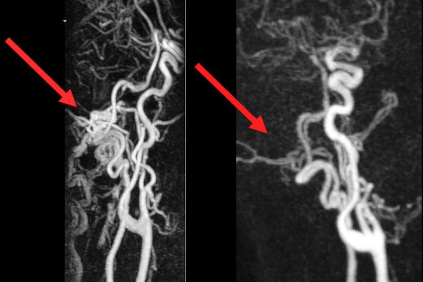 2025 07 28 Mrt Before And After Intervention Thumbnail