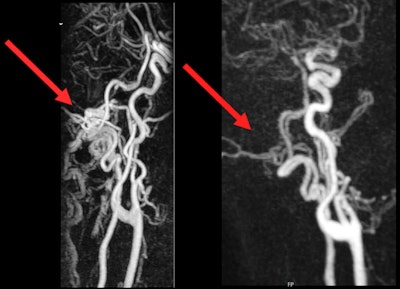 (Left) MRI before intervention. Pathological flow signal in the area of the left occipital condyle can be seen. (Right) MRI after intervention. No more pathological flow signal, and the tinnitus is visible.
