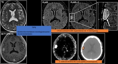 The main differential diagnosis of focal dural metastasis is a meningioma, which is much more common, and they are difficult to differentiate on conventional MRI. To help differentiate them, postcontrast fluid attenuated inversion recovery (FLAIR) sequences can be used. Meningiomas may show up as a hyperintense rim on FLAIR MRI and Ga-68 DOTATATE PET, as meningiomas show intense uptake due to the presence of somastotatin receptors.