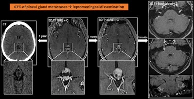 A 56-year-old man with lung cancer with pineal metastasis, which appears as a complex cystic lesion with a solid anterior pole. This finding, which was not present in a CT scan obtained a year earlier, progressed in the MRI scan after three months. In the following months, he developed leptomeningeal dissemination.