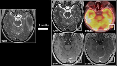 A 45-year-old patient with melanoma presented with a left temporal hemorrhagic metastasis. At the 3-month follow-up, a left occipital cutaneous/subcutaneous metastasis appeared as a soft tissue lesion with contrast enhancement on postcontrast T1 sequences and on PET/CT.