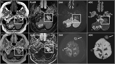 60-year-old woman with breast cancer and bone metastases in the left occipital condyle (square) showing a hypointense focal lesion on T1 sequences without contrast, hyperintense signal on FLAIR sequences and diffusion restriction. Contrast enhancement can be seen on postcontrast 3D T1-weighted sequences, where subtraction sequences may be helpful if fat suppression has not been performed. There is also a cavernoma (empty arrow) in the right cerebellar hemisphere and other bone metastases with diffusion restriction in the calvarium (arrows).