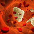 Atherosclerosis Clot