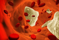 Atherosclerosis Clot
