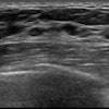 Breast Ultrasound 400