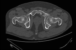 Ct Hip Radiograph Thumbnail