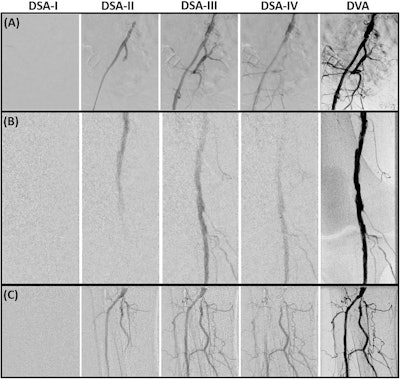 Pelvic (A), femoral and popliteal (B), and cruro-pedal (C) region. The summated digital variance angiography (DVA) image significantly enhances image quality compared to the digital subtraction angiography (DSA) series I–IV (depicting 4 out of 28 (A), 48 (B) and 28 (C) DSA images) of the low dose (LD) acquisitions. Enhancements of iodinated contrast medium (ICM) by DVA depict small vessel structures in detail while the conventional DSA offers a reduced contrast-to-noise ratio (CNR) using LD acquisitions for standalone diagnostic interpretations.