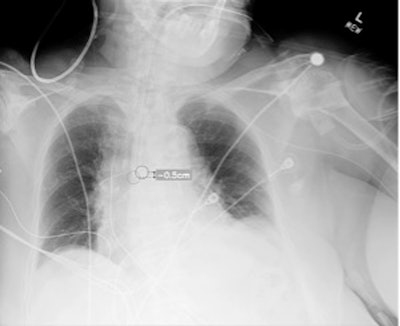 Plain chest radiograph showing overlay from Critical Care Suite, with segmentation of ETT, identification of tube tip and carina, and calculation of distance between them.