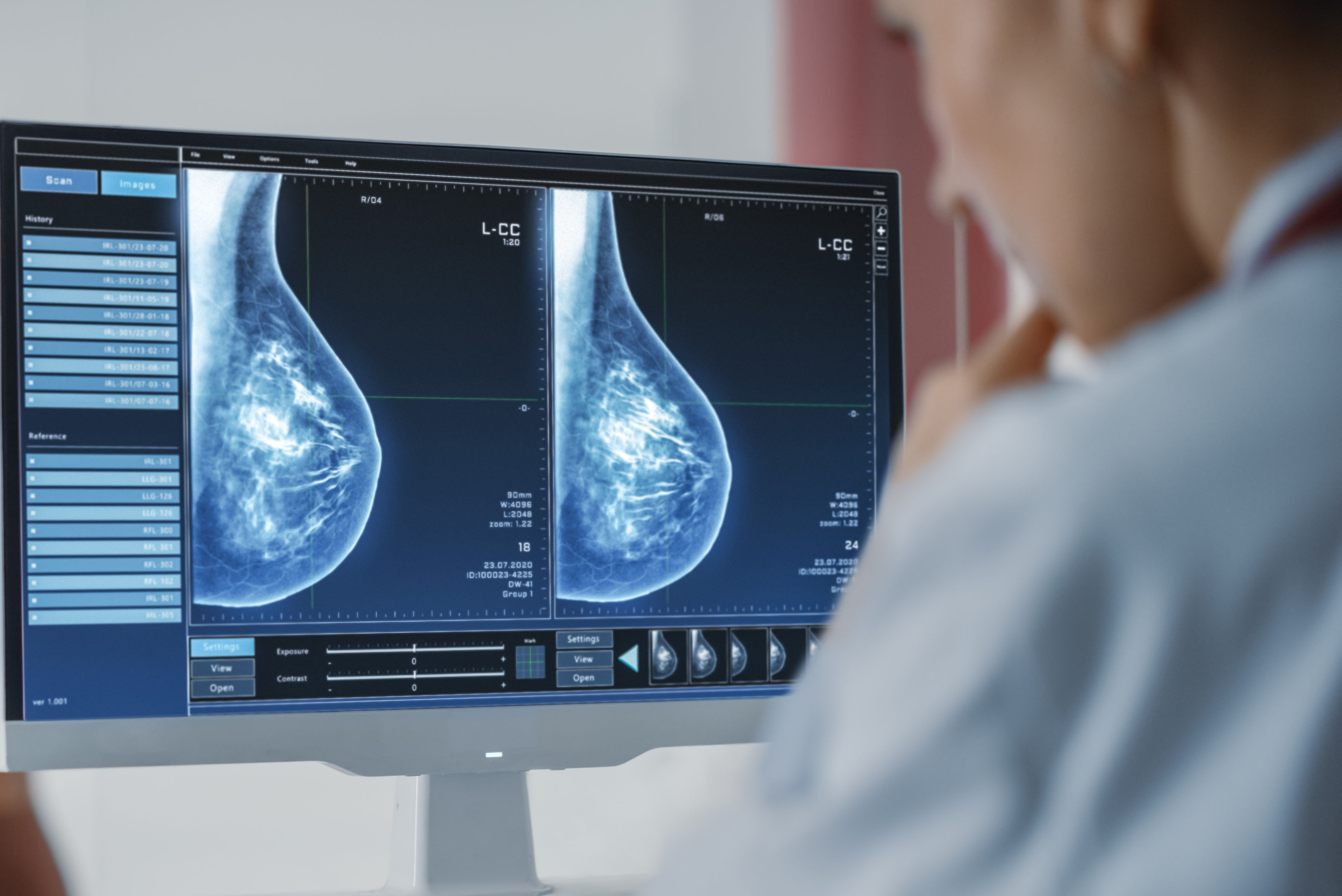 Mammogram Dense Breasts Cropped