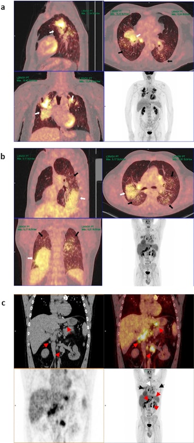 Representative PET/CT images from patients with: (a) high and (b) low SUVmax values and (c) hypermetabolic lymphadenopathy in other extrathoracic areas. (a) Maximum intensity projection (MIP) PET images (bottom right) and sagittal, axial and coronal and PET/CT images of a patient with bilateral pulmonary heterogeneous condensations (white arrows) showing intense metabolic activity up to an SUVmax of 15.42 in the right upper lobe, as well as scattered millimetric nodules (black arrows). (b) MIP PET images and in the sagittal, axial and coronal PET/CT images showing bilateral pulmonary condensations, which are larger on the right side (white arrows), and numerous bilateral millimeter-sized nodules (black arrows). Slight diffuse and heterogeneous increased uptake (up to an SUVmax of 5.17) is observed, even in areas of apparently healthy lung parenchyma. (c) PET, CT, and PET/CT images in coronal and MIP sections in which, in addition to bilateral pulmonary (black arrows) and mediastinal (white arrow) involvement, multiple abdominal lymphadenopathies are observed in the celiac space, gastrohepatic ligament, and retroperitoneum (red arrows), even below the renal artery (red arrowhead).