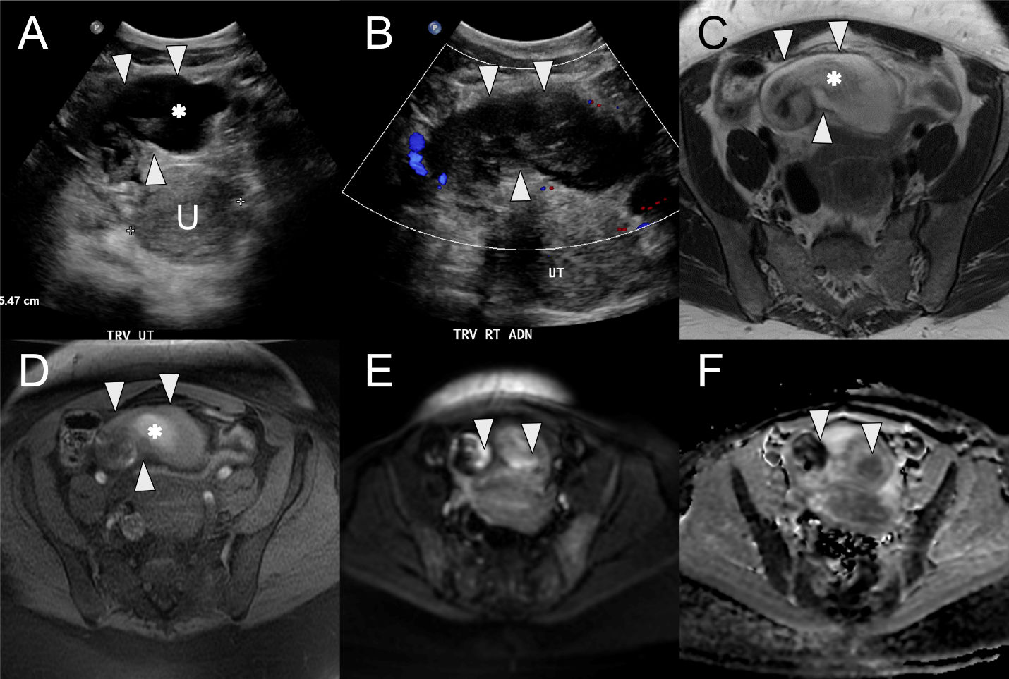 Beware of mimics of female reproductive tract obstruction ...