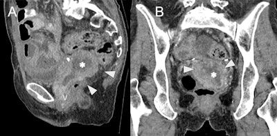 Cystic/necrotic pelvic mass mimicking hydro/hematometra in a 65-year-old female with recurrent ovarian cancer post total abdominal hysterectomy and bilateral salpingo-oophorectomy. Sagittal (A) and coronal (B) contrast-enhanced CT images demonstrate a soft tissue mass (white arrowheads) with central hypodensity, suggestive of cystic/necrotic component (asterisk). The mass is inseparable from the vaginal cuff (V) and mimics an obstructed, retroverted uterus, but instead represents local recurrence post hysterectomy.