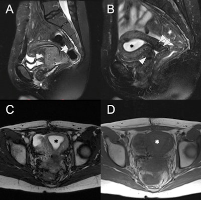 24-year-old female with radiation-induced cervical stenosis. (A) Pretreatment sagittal fat-suppressed T2w MRI of the uterus with a large intermediate to high signal intensity cervical mass (white arrowheads), FIGO stage IIB. (B) Sagittal fat-suppressed T2w MRI postchemoradiation showing marked regression of the tumor (white arrowheads) with reconstitution of the low signal intensity cervical stroma and no measurable residual mass. However, there is new distention of the endometrial cavity (asterisk) with high signal intensity. (C) Axial T2w MRI of the uterus with a distended endometrial cavity (asterisk), suggestive of obstruction. (D) Axial T1w MRI of the uterus shows mild hyperintensity (asterisk) of the endometrial fluid compared to myometrium, suggestive of hematometra