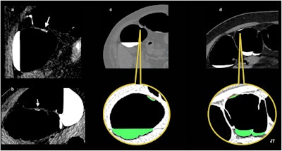 Flat-serrated lesions. This true flat polyp appears as a < 3-mm-high nonpolypoid tissue lesion spreading on the surface at a fixed location on a right lateral decubitus and (b) left decubitus positioning, and covered by a thin film of oral contrast, demonstrating the floating oral contrast-coating sign. (c) The surface of the oral-contrast sign in contact with the polyp is depicted as an undulating red line. The green is an artifice to color liquid in the colon to improve visualization. (d) The stool adhering to the colon wall in another patient appears as the contrast-agent sign in contact with the wall and is seen as a smooth and regular surface with a concave appearance (red line).
