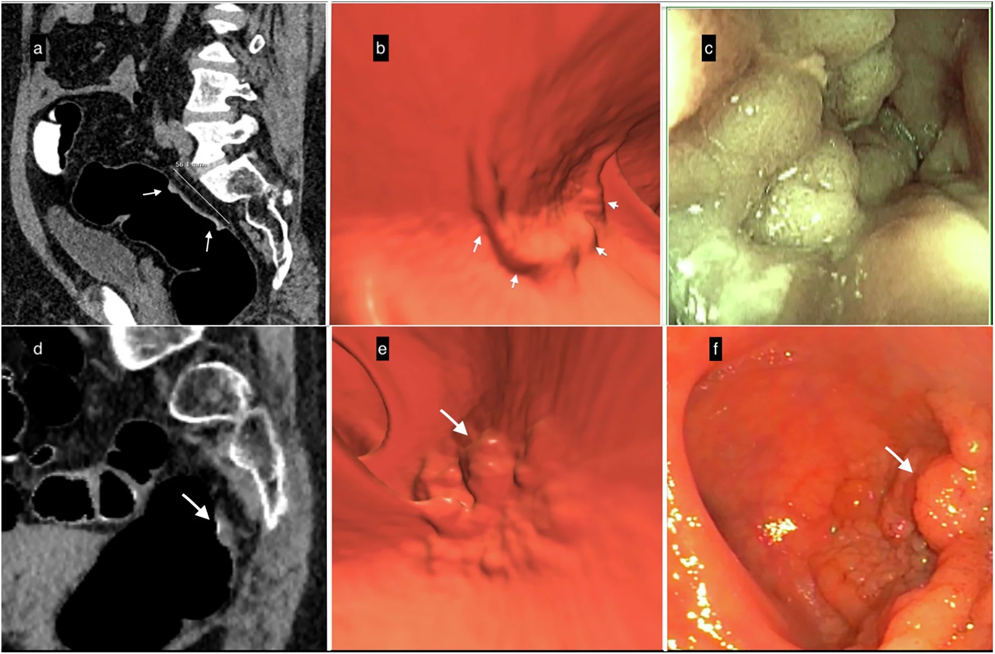 Lateral spreading tumors (LSTs). (a&ndash;c) Example of LST-non-granular (LST-NG). (a) Sagittal 2D-image with 40&ndash;400-HU abdominal window setting indicates a large 5.6-cm lesion with subtle diffuse thickening of the rectal wall (white arrows); the surface is partially covered by a thin layer of orally administered contrast agent. (b) The appearance of the villous mat on the 3D endoscopic view highlights the nodular aspect (white arrows) at the periphery of the lesion. (c) The optical colonoscopy view with the final diagnosis of a carpet villous adenoma with low-grade dysplasia. (d&ndash;f) Example of an LST-granular (LST-G) lesion. (d) Sagittal 2D image indicating nodular thickening of the rectum wall with a 10-mm nodule (white arrow). (e) The 3D endoscopic view visualized the irregular LST with a large nodule (white arrow), similar to (f) the endoscopic image obtained the same day after CTC. It confirmed the diagnosis and allowed mucosectomy with a final pathology report of a tubulous lesion with high-grade dysplasia.