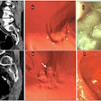 Lateral spreading tumors (LSTs). (a–c) Example of LST-non-granular (LST-NG). (a) Sagittal 2D-image with 40–400-HU abdominal window setting indicates a large 5.6-cm lesion with subtle diffuse thickening of the rectal wall (white arrows); the surface is partially covered by a thin layer of orally administered contrast agent. (b) The appearance of the villous mat on the 3D endoscopic view highlights the nodular aspect (white arrows) at the periphery of the lesion. (c) The optical colonoscopy view with the final diagnosis of a carpet villous adenoma with low-grade dysplasia. (d–f) Example of an LST-granular (LST-G) lesion. (d) Sagittal 2D image indicating nodular thickening of the rectum wall with a 10-mm nodule (white arrow). (e) The 3D endoscopic view visualized the irregular LST with a large nodule (white arrow), similar to (f) the endoscopic image obtained the same day after CTC. It confirmed the diagnosis and allowed mucosectomy with a final pathology report of a tubulous lesion with high-grade dysplasia.