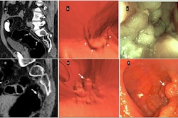 Lateral spreading tumors (LSTs). (a–c) Example of LST-non-granular (LST-NG). (a) Sagittal 2D-image with 40–400-HU abdominal window setting indicates a large 5.6-cm lesion with subtle diffuse thickening of the rectal wall (white arrows); the surface is partially covered by a thin layer of orally administered contrast agent. (b) The appearance of the villous mat on the 3D endoscopic view highlights the nodular aspect (white arrows) at the periphery of the lesion. (c) The optical colonoscopy view with the final diagnosis of a carpet villous adenoma with low-grade dysplasia. (d–f) Example of an LST-granular (LST-G) lesion. (d) Sagittal 2D image indicating nodular thickening of the rectum wall with a 10-mm nodule (white arrow). (e) The 3D endoscopic view visualized the irregular LST with a large nodule (white arrow), similar to (f) the endoscopic image obtained the same day after CTC. It confirmed the diagnosis and allowed mucosectomy with a final pathology report of a tubulous lesion with high-grade dysplasia.