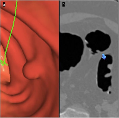 Primary 3D polyp detection: 3D-2D interaction. (a) 3D-endoscopic view makes detecting a candidate sessile polyp easier. (b) The 2D-axial image confirms the polyp’s soft-tissue value, bookmarking on the 2D image (blue arrow) the specific location shown on the 3D image.