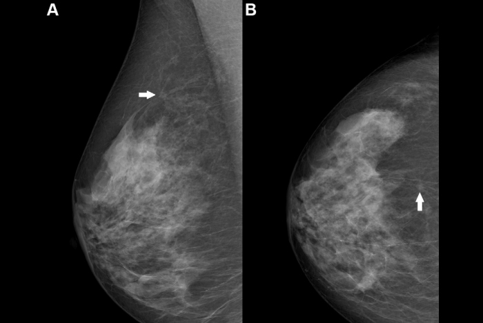 2025 08 12 Rsna Ai Mammography Challenge Thumbnail
