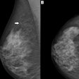 2025 08 12 Rsna Ai Mammography Challenge Thumbnail