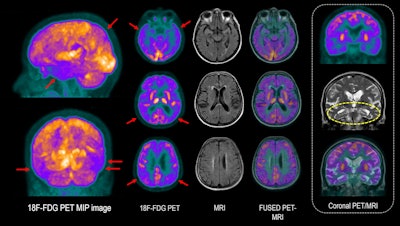 75-year-old woman with anosmia, bradykinesia, mild resting tremor in the right arm, and cognitive impairment. Patient is currently on levodopa treatment, with improvement of motor symptoms. Brain F-18 FDG PET scan shows decreased metabolism in the temporal and parietal lobes (red arrows), with left predominance. To a lesser extent, a slight decrease in cortical metabolism is observed in the frontal regions. MRI shows mesial temporal lobe atrophy with slight decrease in bilateral hippocampal volume (MTA 2) (yellow circle), with reduced metabolism evident in PET images. PET/MRI reflects cortical involvement with Alzheimer's disease-type neurodegenerative pattern.