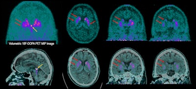 70-year-old man with involuntary movements and tremors in the left lower limb for two years. He also suffered from anxiety and depression. History of treatment with clebopride due to functional gastrointestinal disorders. This dopamine antagonist drug could explain altered movements of pharmacological origin. Brain PET scan with F-18 DOPA shows evident decrease in tracer uptake in both striatum nuclei with right predominance (red arrows), depicting presynaptic dopaminergic deficit of the nigrostriatal pathway, compatible with Parkinson´s disease. (Yellow arrow) Incidental tracer uptake in calcified pituitary gland. (Upper row) PET images. (Lower row) Fused PET/CT images.