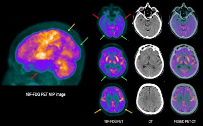 76-year-old woman with involuntary movements and tremors in the upper limbs, disorientation, and cognitive impairment (memory loss). Brain F-18 FDG PET scan shows significant decrease in cortical metabolism in the temporal lobes (red arrows) and parietal regions (yellow arrows), lobes that are usually affected both in dementia with Lewy bodies (DLB) and Alzheimer’s disease (AD). In this case, involvement of the occipital lobes is also seen (green arrows), which is not usually seen in AD. Cortical involvement is slightly asymmetrical, with the right side being more involved. A slight decrease in radiotracer concentration is also observed in the frontal lobes. The pattern of cortical metabolism involvement is compatible with DLB, also known as Lewy body dementia.