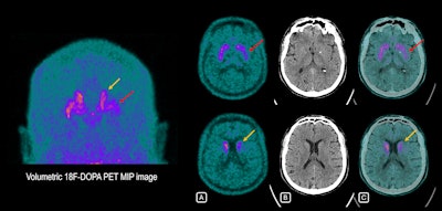 46-year-old man with involuntary tremors and muscular stiffness in right upper and lower limb. He was referred due to loss of sense of smell (anosmia), which started more than 10 years previously. Electromyography was normal, but mild cognitive impairment was apparent. Brain F-18 DOPA PET scan shows decreased tracer uptake in left putamen (red arrows) and, to a lesser extent, in the left caudate nucleus (yellow arrow), reflecting dopamine pathway deficiency, compatible with early onset Parkinson's disease. Right striatum with normal typical “comma shape” uptake. (A) PET images. (B) CT images. (C) Fused PET/CT images. All figures courtesy of Dr. Magali Hovsepian et al and presented at ECR 2025.