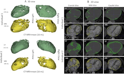 Images of epicardial adipose tissue segmentation in two male individuals with type 2 diabetes mellitus, aged 56 (individual 1) and 64 (individual 2) years, show volume differences less (upper two rows in A and B) or greater (lower two rows in A and B) than the mean volume difference of 16 mL between CT (in green) and MRI (in yellow). Deep learning was used for CT segmentation and semiautomated thresholding for MRI. (A) CT and MR images in the three-dimensional (3D) view. Both imaging modalities are presented from left and right views. (B) CT and MR images in the two-dimensional (2D) view. The stacked images consist of three selected 2D sections: cranial, mid, and caudal sections. All images are noncontrast images.