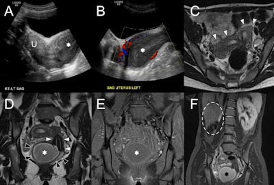 OHVIRA syndrome. (A) Sagittal ultrasound image at the level of the uterus (U) shows echogenic contents distending the vagina (asterisk) with (B) no color Doppler flow. (C) Axial T2w MRI shows two widely splayed uterine horns (white arrowheads). (D) Coronal T2w MRI demonstrates two separate cervices (white arrowheads) and vaginal cavities (black arrowheads) consistent with uterine didelphys. The right hemivagina is distended with fluid (asterisk), consistent with obstruction. (E) Coronal fat-suppressed T1w MRI at the same level shows low signal intensity of the vaginal contents (asterisk), suggestive of hydrocolpos. (F) Wide field-of-view fat-suppressed T2w MRI shows right renal agenesis (dashed line) ipsilateral to the side of vaginal obstruction (asterisk). All figures courtesy of Dr. Monish Ahluwalia, Dr. Andrew Chung, and EJR.