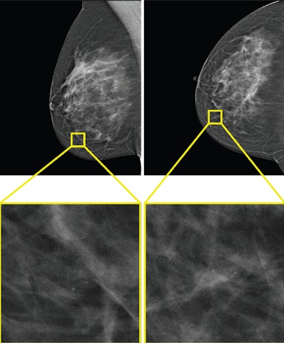 The only example of a screening exam with a screen-detected cancer that would have been missed by AI in a hybrid reading strategy based on the AI uncertainty score of the entropy of the mean probability of malignancy (PoM) score of the most suspicious region. During screening, a 52-year-old woman was recalled following arbitration scoring of the right breast as Breast Imaging Reporting and Data System (BI-RADS) 4 after the first and second radiologists scored the right breast as BI-RADS 1 and 4, respectively. This woman would not have been recalled if the examination was read by the AI model, which assigned a PoM score of 30, which would be classified as a certain prediction with an uncertainty quantification of 0.57. Both the mediolateral oblique (left) and craniocaudal (right) views of the affected breast are shown. The boxes indicate the calcifications found during screening, and the final diagnosis of this examination was ductal carcinoma in situ.