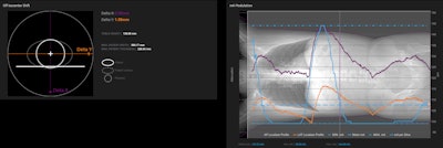 Detailed data on patient positioning in the gantry in relation to CT isocenter and mA modulation.
