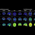 2025 09 12 Long Covid Brain Images Thumbnail