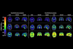 2025 09 12 Long Covid Brain Images Thumbnail