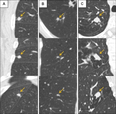 Low-dose CT images show examples of screen-detected pulmonary nodules (arrows) where the deep-learning algorithm provides a more accurate malignancy risk estimation than the Pan-Canadian Early Detection of Lung Cancer (PanCan) model on axial (top), coronal (middle), and sagittal (bottom) planes. (A) Image shows a 9.7-mm malignant nodule (arrows) with a high deep-learning risk score (32.3%) and low PanCan risk score (3.2%) in a 74-year-old male participant diagnosed with squamous cell carcinoma. (B) Image shows a 6.8-mm malignant nodule (arrows) with a high deep-learning risk score (15.9%) and low PanCan risk score (1.2%) in a 71-year-old male participant diagnosed with adenocarcinoma. (C) Image shows a 19 mm benign nodule (arrows) with a low deep-learning risk score (4.7%) and high PanCan risk score (32.7%) in a 50-year-old female participant. Additional PanCan input features used in the model were retrieved from original trial records, as follows: (A) negative for family history of lung cancer, negative for emphysema, negative for spiculation, negative for upper lobe location, nodule count: four; (B) negative for family history of lung cancer, negative for emphysema, negative for spiculation, negative for upper lobe location, nodule count: two; (C) negative for family history of lung cancer, positive for emphysema, negative for spiculation, positive for upper lobe location, nodule count: one. Images and caption courtesy of the RSNA.