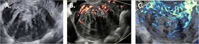 Sagittal fibroid images obtained by the different ultrasound techniques. 2D B-mode ultrasound (A); 2D power Doppler (B); 2D microvascular flow (C).
