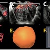 3D power Doppler images of the same patient. Sagittal view (A), transversal view (B), and coronal view (C). 3D power Doppler reconstruction (D) with a 3D power Doppler volume (E) and a histogram (F) as output of 3D power Doppler ultrasound with vascular indices as result.