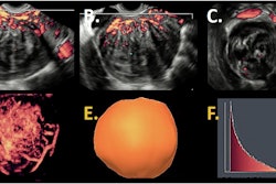 3D power Doppler images of the same patient. Sagittal view (A), transversal view (B), and coronal view (C). 3D power Doppler reconstruction (D) with a 3D power Doppler volume (E) and a histogram (F) as output of 3D power Doppler ultrasound with vascular indices as result.