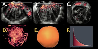 3D power Doppler images of the same patient. Sagittal view (A), transversal view (B), and coronal view (C). 3D power Doppler reconstruction (D) with a 3D power Doppler volume (E) and a histogram (F) as output of 3D power Doppler ultrasound with vascular indices as result.