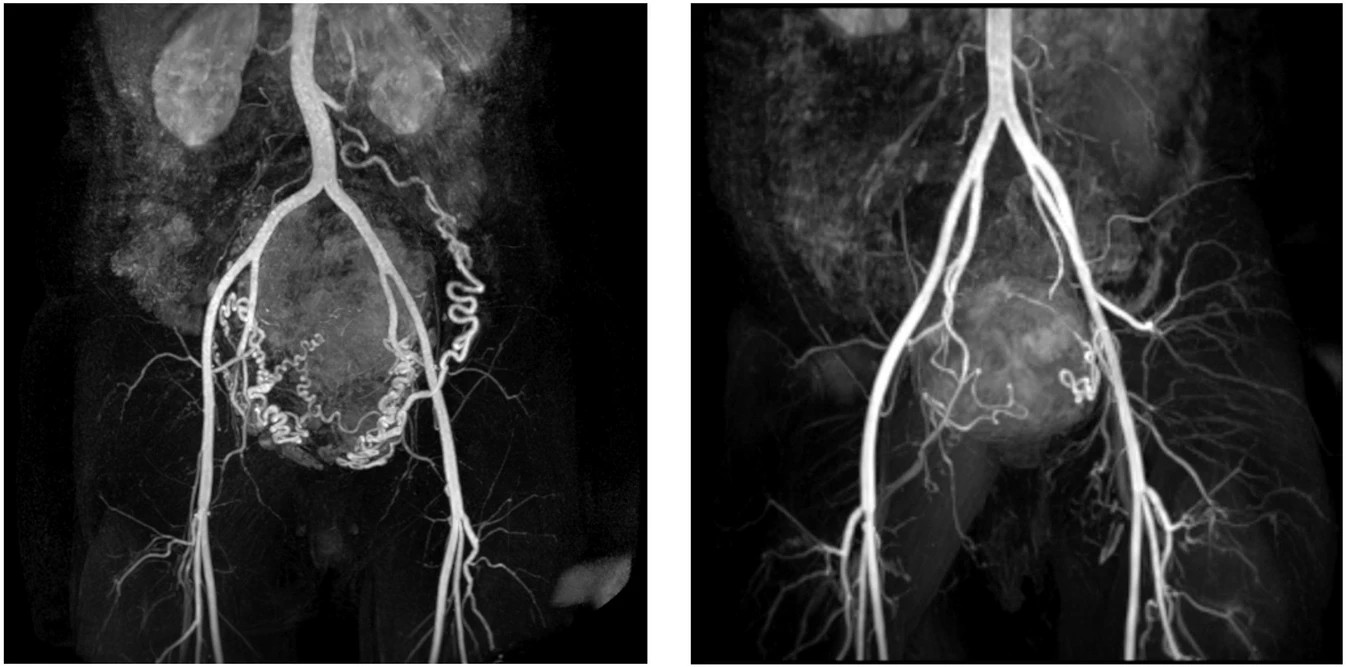 Dutch authors cast light on uterine fibroids | AuntMinnieEurope