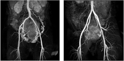 MR angiography images of subserosal/intramural uterine fibroid with a diameter of 144 mm in the dorsal uterine wall and hypertrophic arteria overica in a 41-year-old woman (left), and subserosal pedunculated fibroid of a 42-year-old woman with a 69 mm diameter (right).