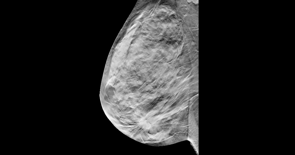 Breast Tomosynthesis Digital Social